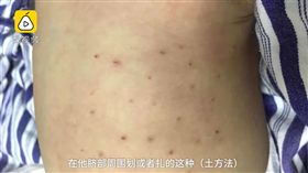 嬰兒半夜哭鬧 父母信偏方插他40針險喪命（圖／梨視頻）