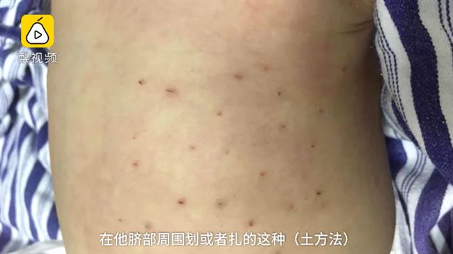 嬰半夜哭鬧！父母信偏方刺40個血洞