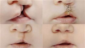 兔唇,先天性唇顎裂,手術,幹細胞,哥倫比亞,再生,臍帶血　圖／翻攝自推特　