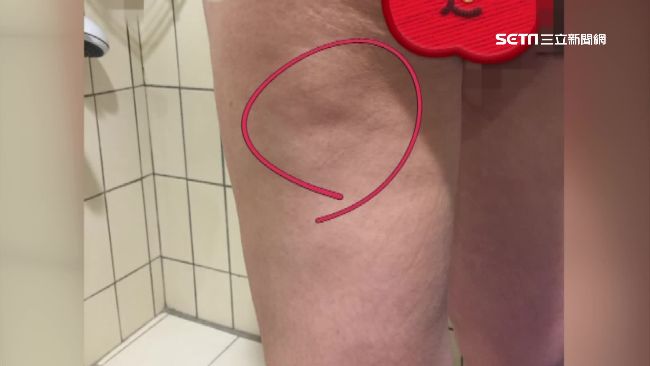 花30萬抽脂！女業務的腿卻「凹了」