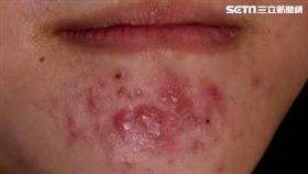 月經,成大醫院,生理痘