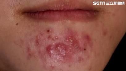 月經來之前「冒不停」　惱人的生理痘
