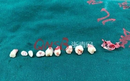 男童跌倒後狂吐　腦中竟取出9顆牙齒