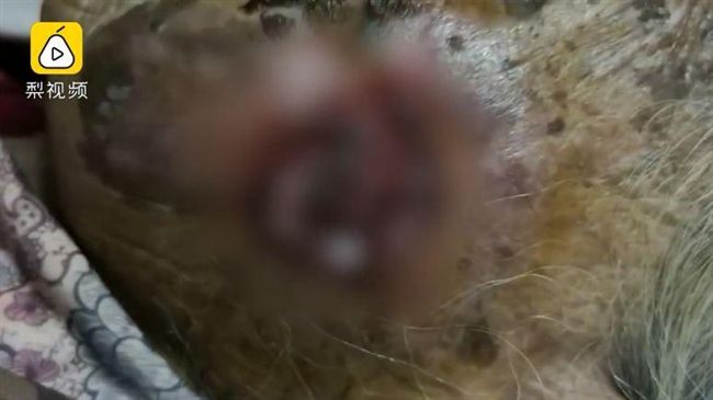 9旬婦洗臉弄破斑　50隻蛆蟲傷口爬