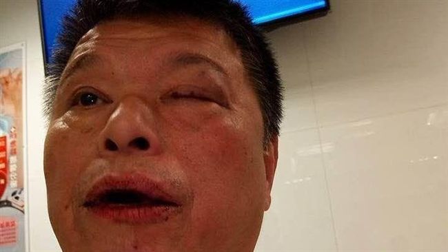 開車遇暴力酒客追打　運將只剩一隻眼
