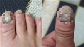  困擾17年「殭屍指甲」灰裂奇癢　醫院無奈退掛號費！女苦笑：痛的要命（圖／爆怨公社）