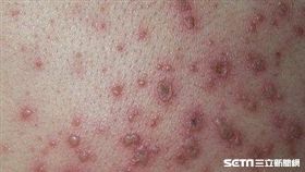 水痘出疹症狀水疱樣態。（圖／台北市衛生局提供）