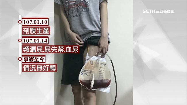 婦找名醫剖腹　子宮破洞掛尿袋9個月