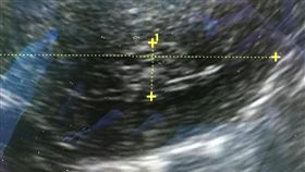 避孕器竟藏婦人體內30多年，碎成針狀插進子宮肌肉層。（圖／翻攝鄭丞傑醫師健康教室臉書）