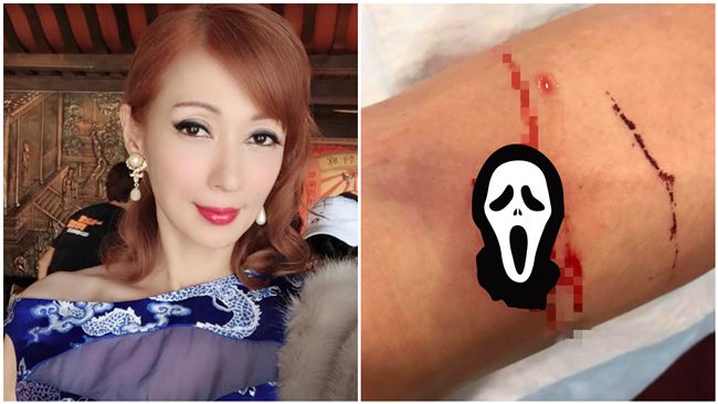 女星踩空摔下皮開肉綻　傷口照超嚇人