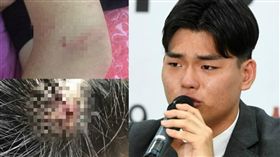 李碩澈指控公佈遭暴打時的受傷照，包括頭頂流血，手臂、小腿淤青。（圖／翻攝自koreastardaily）