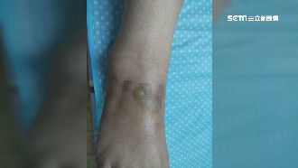 工作燙傷請假　她怒控老闆扣薪又趕人