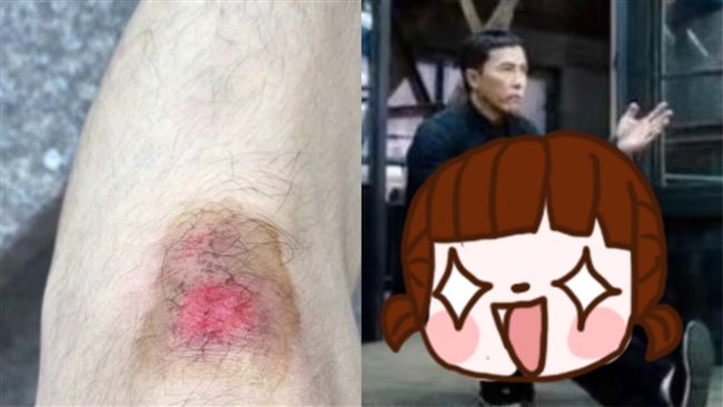 腿傷怎麼大號？「這圖」讓網友笑噴