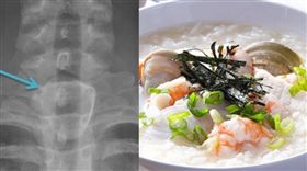 男子吃海鮮粥吞下蛤蜊殼　險喪命（組圖／翻攝自許秉毅醫師臉書）