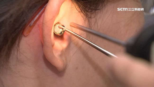 鈕扣電池塞耳　男童耳膜燒破洞險失聰