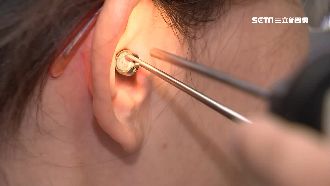 鈕扣電池塞耳　男童耳膜燒破洞險失聰