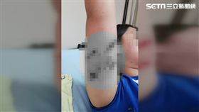 養4隻比特犬被咬到3度送急診　醫見傷口「棉棒直接穿過」