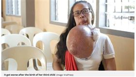 下顎痛別輕忽！婦下巴長「比西瓜大」巨瘤　花光積蓄治不好 圖/翻攝自鏡報