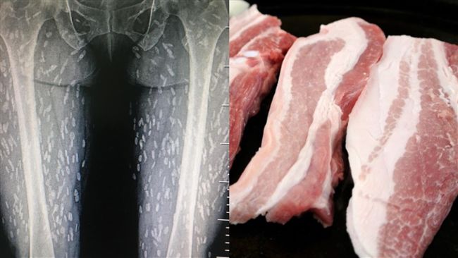 生食豬肉！她體內爬滿「百隻寄生蟲」