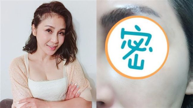 眼白全是血！梁佑南爆「眼中風」送醫