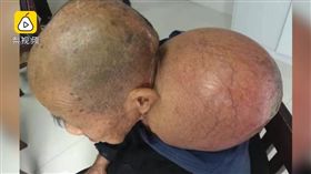 中國大陸,老翁,蘇德朋,腫瘤（圖／翻攝自梨視頻）