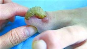 指甲肥厚症與穿不合腳的鞋子有關，長期因擠壓就易造成指甲變形。（圖非新聞當事人／擷取自騰訊新聞網）