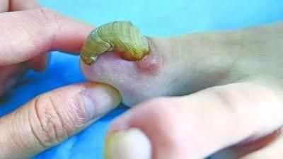 外傷6年未剪...大拇指甲竟成鷹嘴