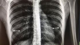 她照X光驚見乳頭「2條金屬槓」　醫師笑了媽媽卻超火大
翻攝自推特