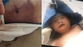 內蒙古男童遭食肉菌感染　後背幾乎被「吃掉」（圖／微博）