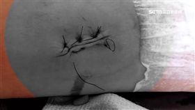 母崩潰控！護理師剪肉2cm 嗆男童「哭什麼哭」
