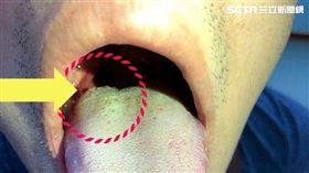 彰化博元婦產科,​蔡鋒博,菜花,陰道,無菌
圖／醫師提供