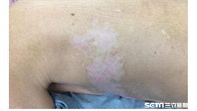 新光醫院疼痛照護中心主任陳瑞源分享帶狀疱疹後患者案例。（圖／記者楊晴雯攝）