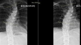 脊椎側彎。患者頸椎、脊椎扭曲似條飛龍，經KKT聲波動力平衡系統矯正7度，改善其不明的胸悶頭痛及背痛。（圖／活力得中山脊椎外科醫院授權提供）