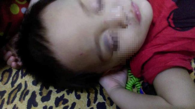 高雄傳虐童！2歲男童被毆到雙眼黑青