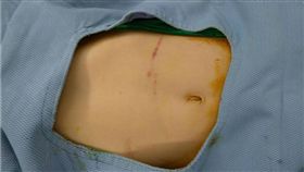 離奇車禍男童胃遭安全帶勒斷  腹部勒痕淺台中市一名12歲男童繫安全帶坐在後座，沒想到發生追撞意外，男童腹部僅有淺紅色勒痕卻腹痛難耐，檢傷發現男童胃部竟遭勒斷，經緊急手術接合才恢復功能。（澄清醫院提供）中央社記者郝雪卿傳真  107年11月12日