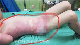 桃園,幼兒園,燙傷,熱湯,加護病房,水泡,