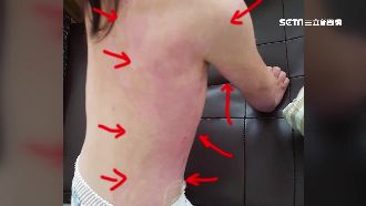 愛女24％燙傷　父嘆：疤痕仍增生…