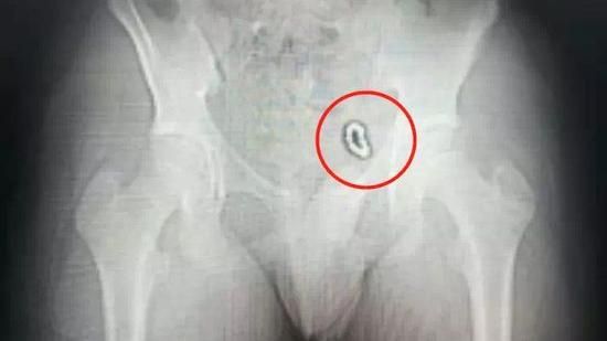 男將磁球塞雞雞！想靠磁力吸出結果…