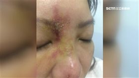 玻尿酸微整惡夢! 打錯位置女控害毀容
