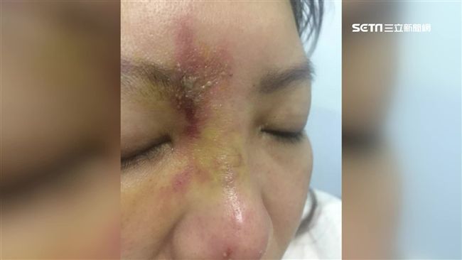 玻尿酸疑打進血管　女控毀容差點險瞎
