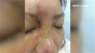 玻尿酸疑打進血管　女控毀容差點險瞎