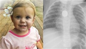 水銀電池,吞食,食道,檢查,醫院,X光,澳洲,墨爾本,吐血　圖／翻攝自臉書　