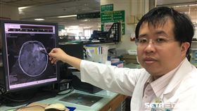 南投醫院陳筠方主任指出病人腦部腫瘤（圖／南投醫院提供）
