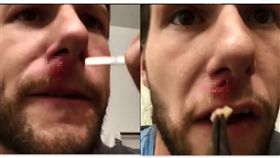  美國有一名男子臉上出現一個類似小腫瘤的傷口，就醫之後持續服用抗生素，但是傷口還是讓他感到相當不舒服，於是他決定自己「手動」將傷口裡的不明物體拔出，並一邊錄影記錄，影片中可以看到他從臉上的傷口拉出一個白色塊狀物，之後皮膚留下一個大大的「黑洞」，畫面看起來相當驚人。（圖／翻攝自 Instagram:chrisalexyocom）
