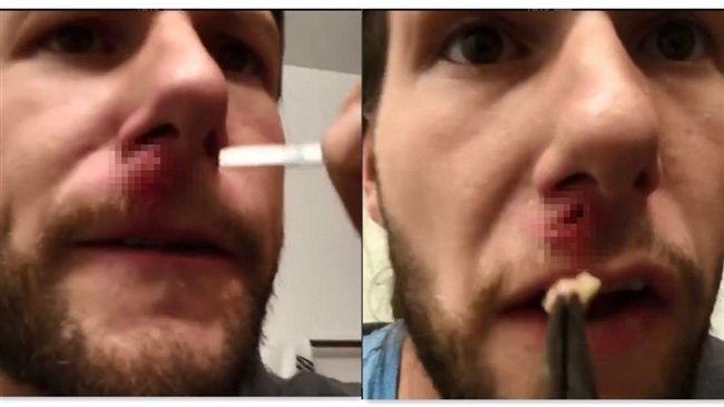 男從化膿中拔出塊狀物　臉留下大黑洞