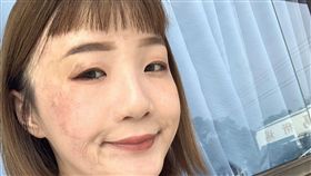 回歸社會是燒燙傷者重要的課題，但他們普遍曾被歧視。23歲李欣蓉出生3個月就被燒傷而腳趾截肢，領有身心障礙手冊，面試屢失敗且被問：「為什麼要請受傷的人？」讓她受創。