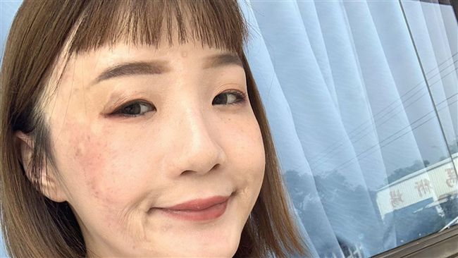 燙傷者回社會遇歧視　盼友善求職環境