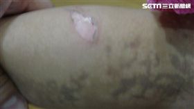 NEMO,人體彩繪寶寶,彰化博元婦產科,蔡鋒博,色素失調症,黑色素,流產,小丑魚