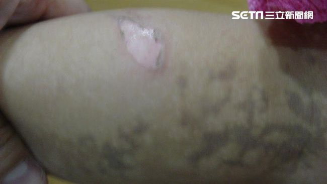 罹罕病成「小丑魚人」　懷四胎全流產