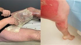 電子菸,爆炸,過熱,戒菸,睪丸,燙傷,英國,煙火,褲子　圖／翻攝自Metro 